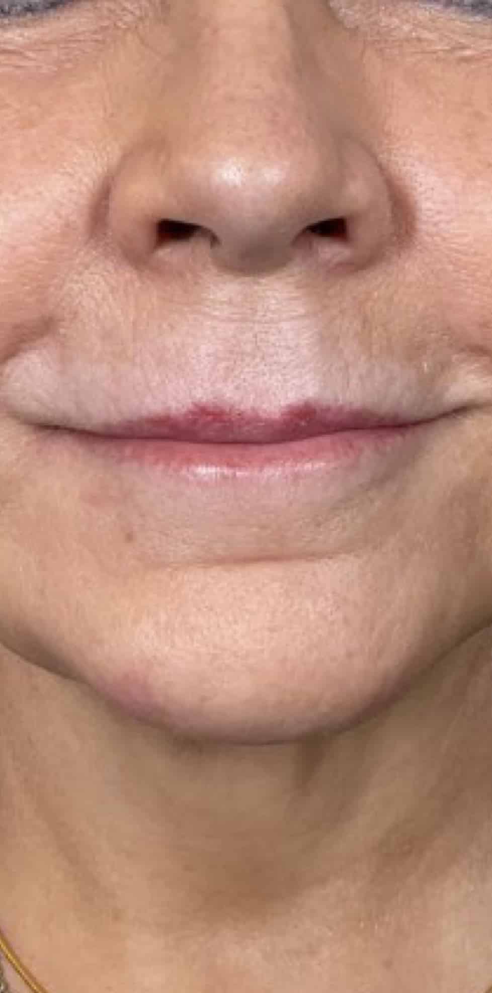 Before Image: Filler - front