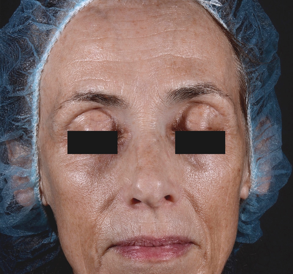 After Image: Three For Me Rejuvenation - front