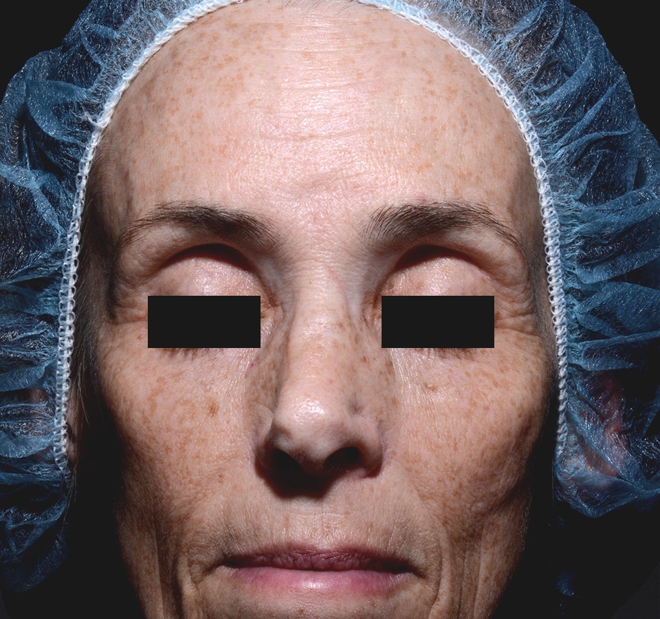Before Image: Three For Me Rejuvenation - front