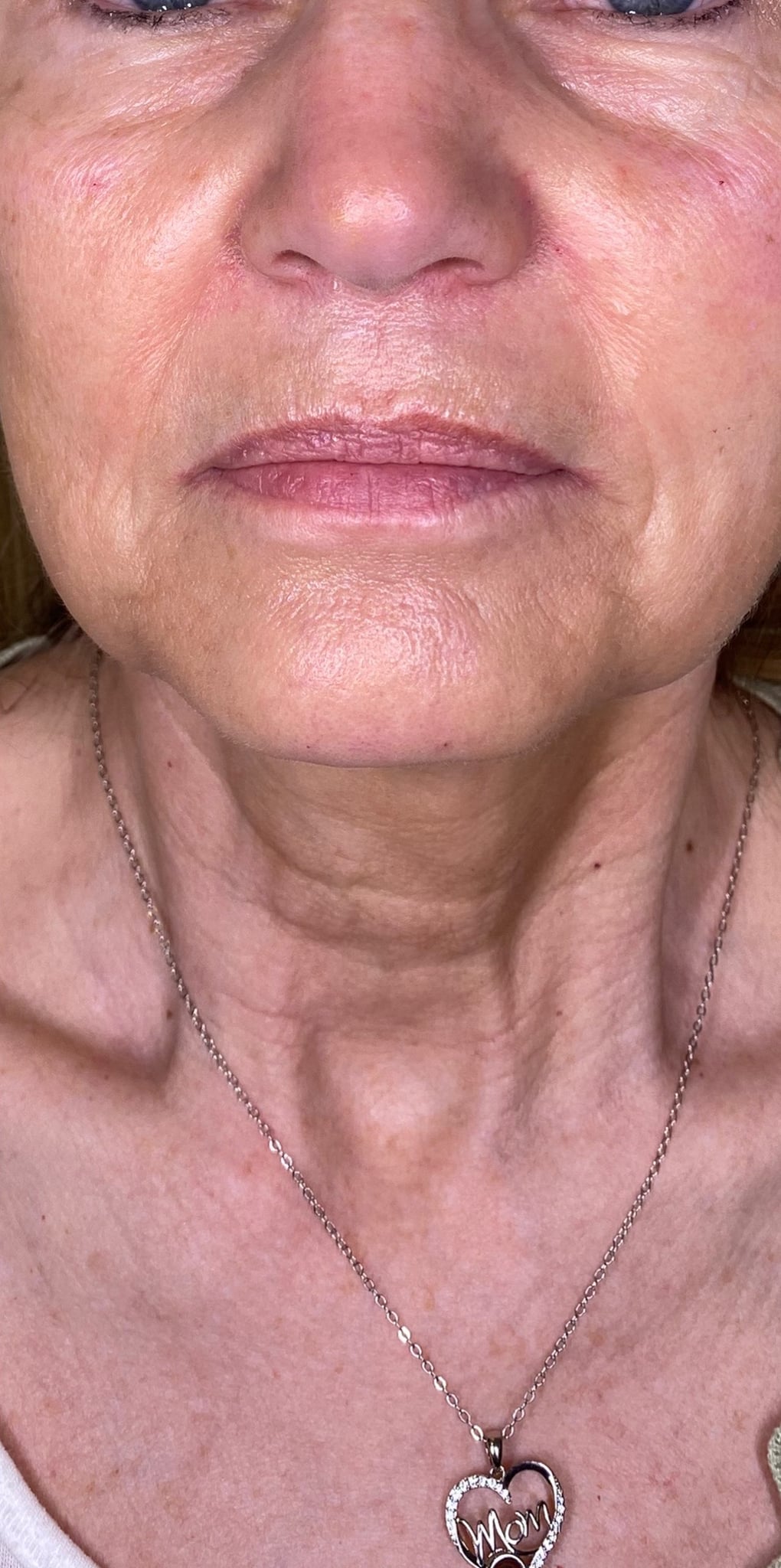 After Image: Filler - front