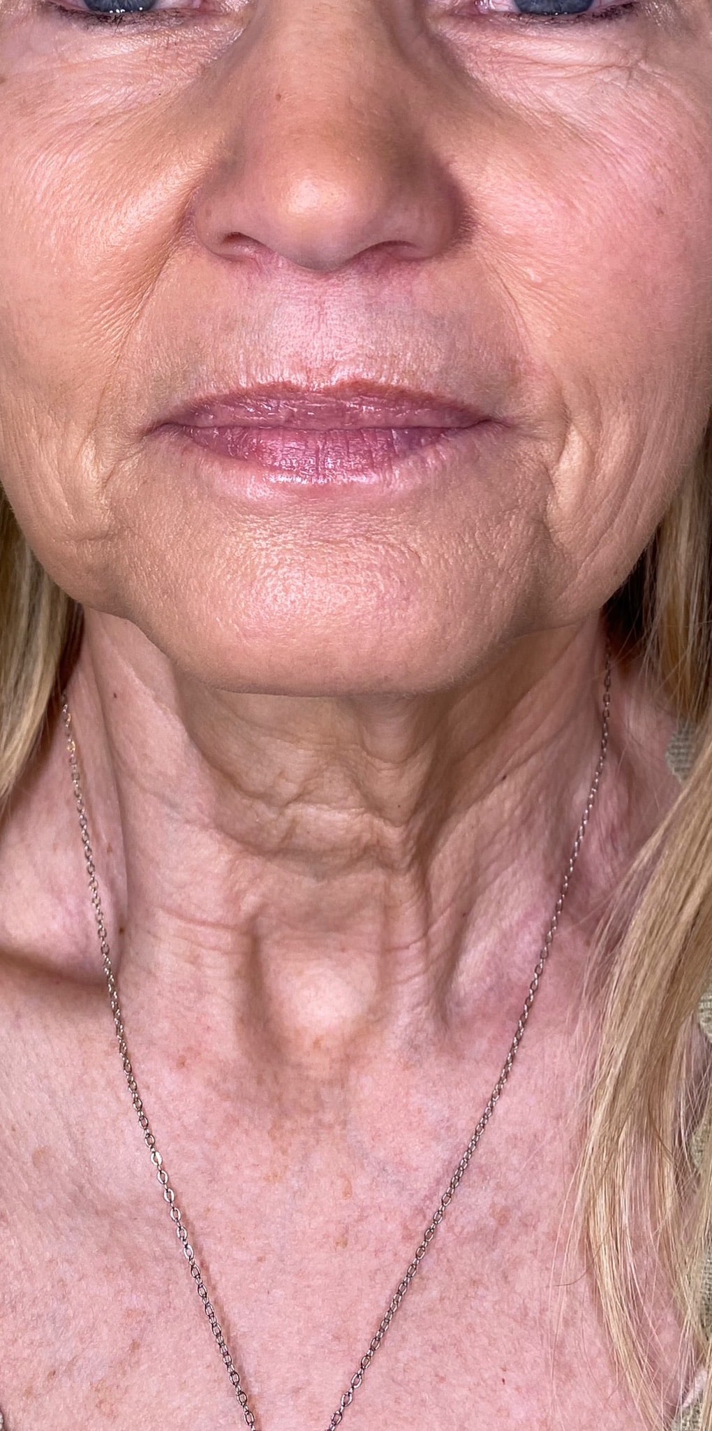 Before Image: Filler - front