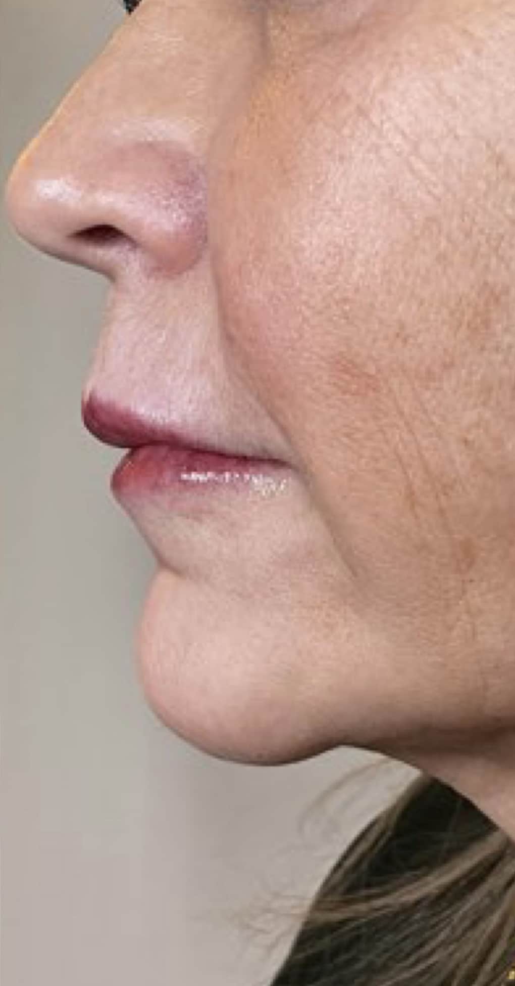 After Image: Filler - left-side