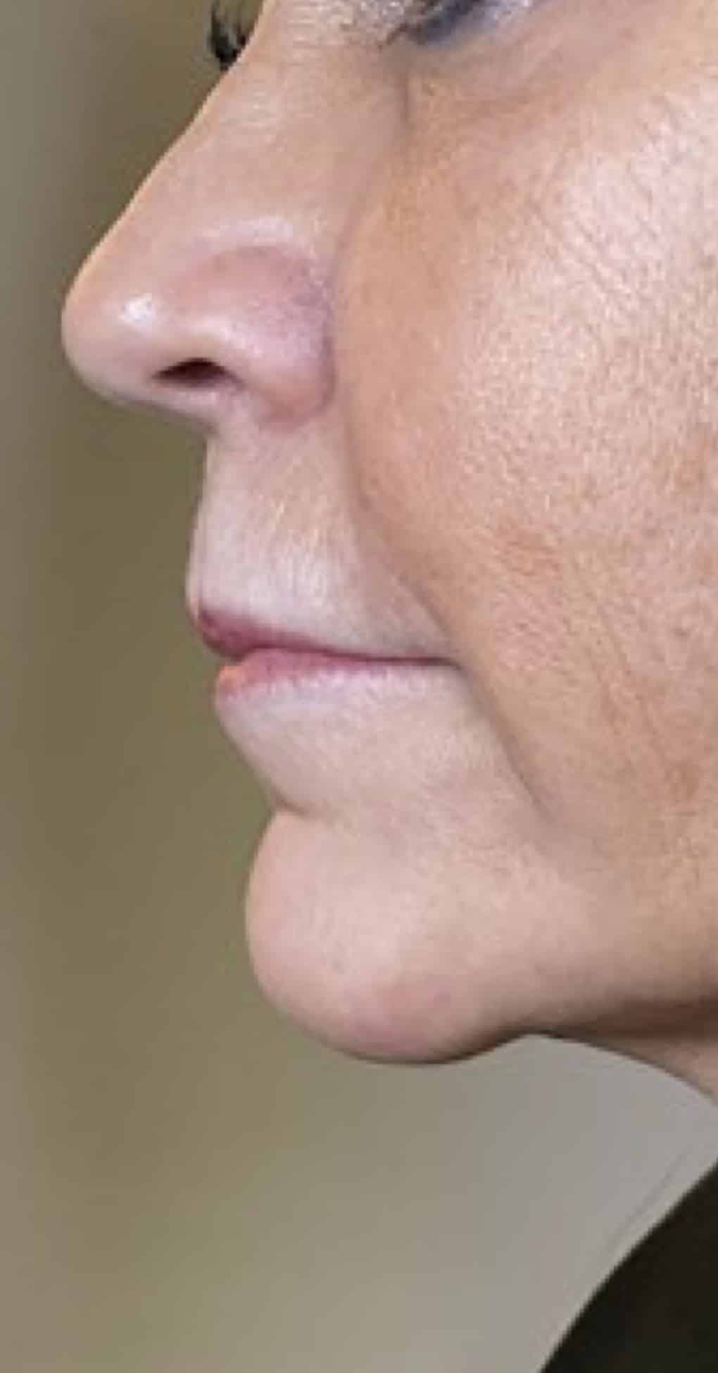 Before Image: Filler - left-side