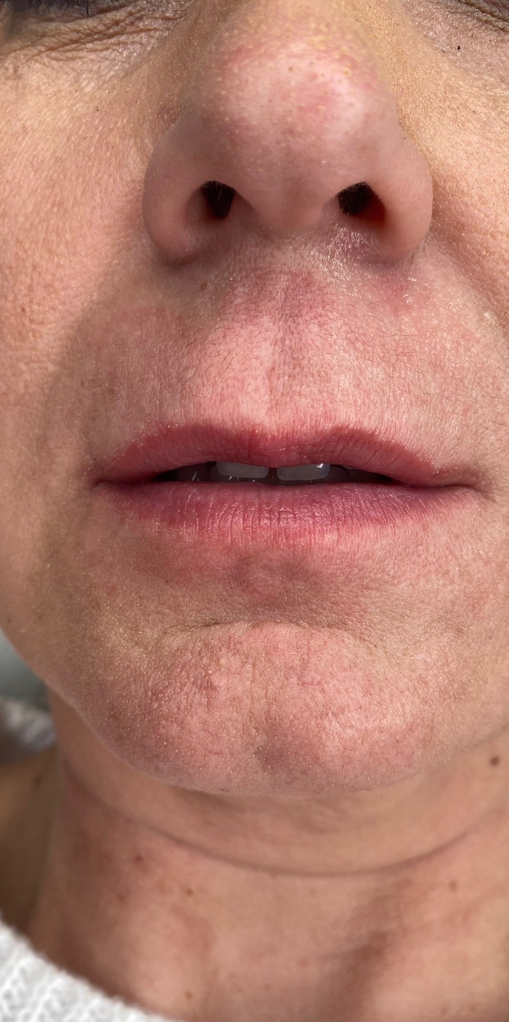 Before Image: Filler - front