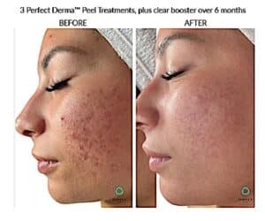 Perfect derma 1