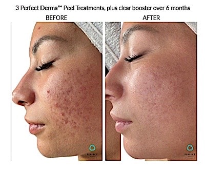 Perfect derma 1