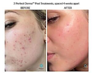 Perfect derma 2
