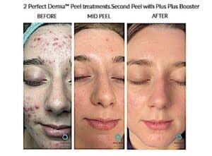 Perfect derma 3