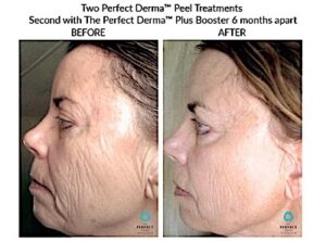 Perfect derma 4