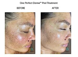 Perfect derma 5